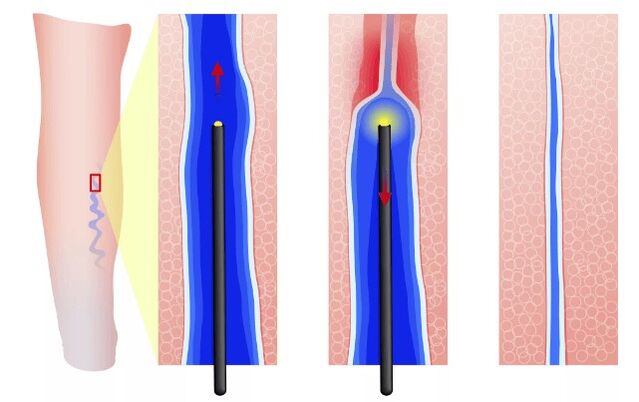 Endzazal electrocoagulation