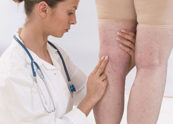 Varicose vein diagnosis