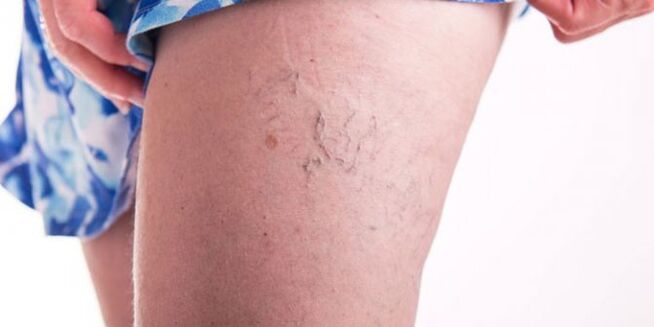 Varicose veins on the leg