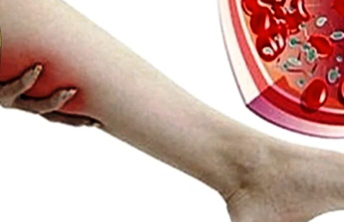 Varicose veins on the leg