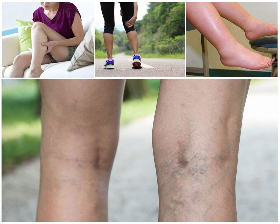 Start of varicosis