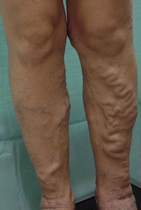 Varicose veins on their feet
