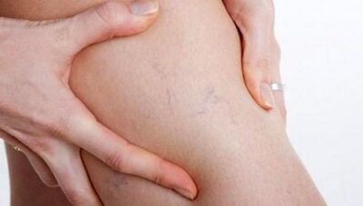 As varicose veins are manifested on their feet