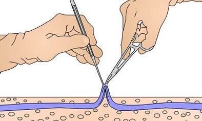 Work for varicose veins