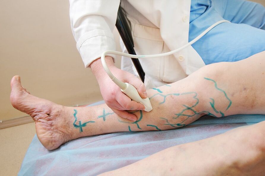Preparation for miniphlebectomy - marking the perforator of the leg, performing an ultrasound scan
