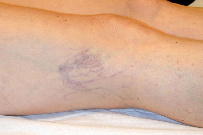Stage C1 – reticular veins with a diameter of about 1 mm