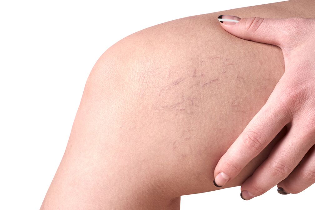 Stage C1 – spider veins