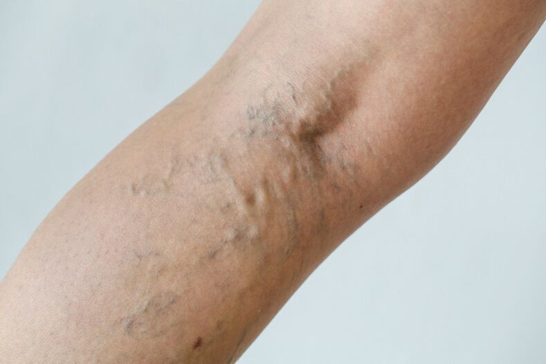 Stage C2 – dilated popliteal veins (Thierry's perforator) and reticular veins
