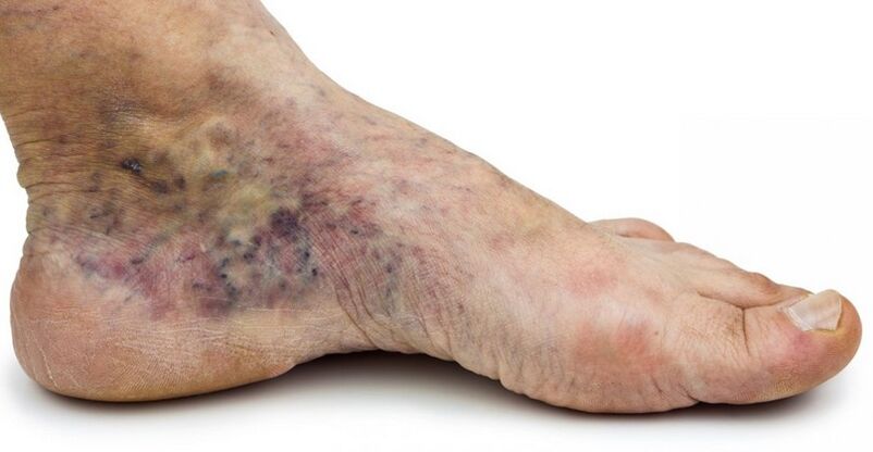 Stage C4c – crown of the foot, phlebitis in the center