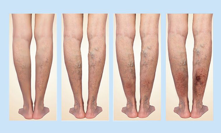Varicose vein stages