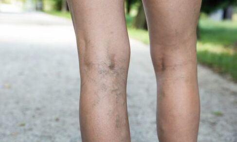 the appearance of veins, a symptom of varicose veins
